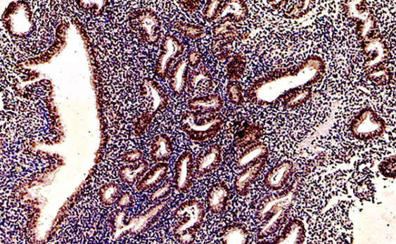 Molecular classification and fertility-sparing outcomes in endometrial cancer and atypical endometrial hyperplasia