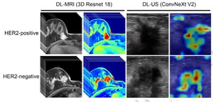 Deep learning predicts HER2 status in invasive breast cancer from multimodal ultrasound and MRI