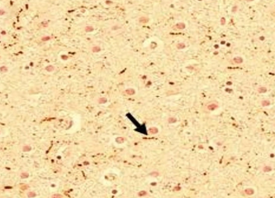 TUDCA combined with Syndopa protects the midbrain and gut from MPTP toxicity in a Parkinson’s Disease mouse model: Immunohistochemical evidence