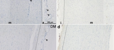 Diabetes-induced redistribution of mast cells to the adventitia in ascending aortic aneurysms