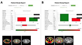 Beyond BMI: An opinion on the clinical value of AI-powered CT body composition analysis