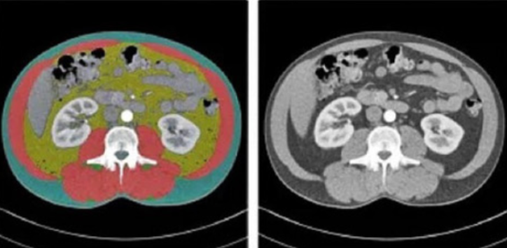 Beyond BMI: An opinion on the clinical value of AI-powered CT body composition analysis