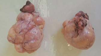 Extraovarian fibrothecomas: Two case reports and comprehensive review of ovarian sex cord-stromal fibroma-thecoma tumors