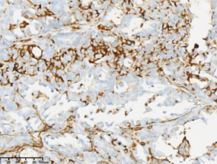 Endometrial mesonephric-like adenocarcinoma: Clinicopathologic features, treatment, and outcomes