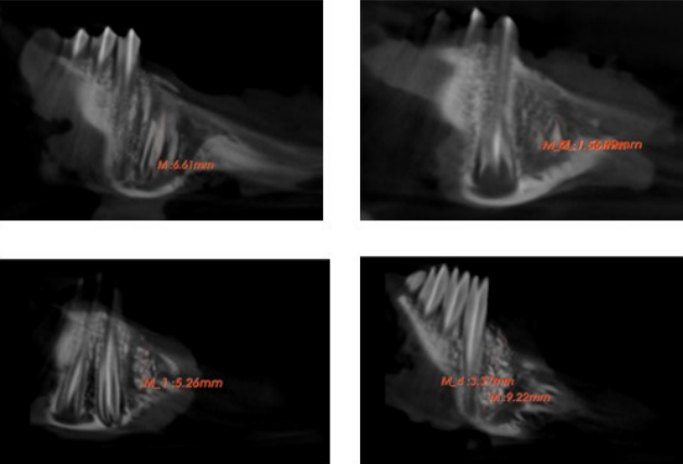 Sclerostin antibody promotes alveolar bone regeneration after tooth extraction