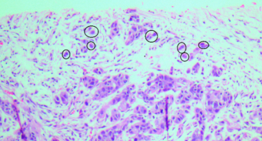 Tumor budding in preoperative breast biopsies predicts sentinel lymph node metastasis 