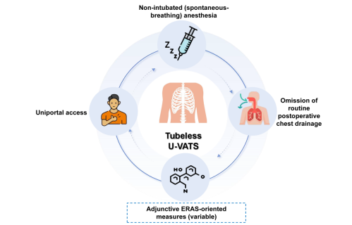 Tubeless uniportal VATS in thoracic surgery – Indications, ERAS pathways, and outcomes: A review