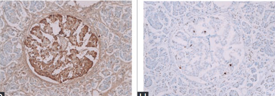 Apoptosis of pancreatic β-cells in Type 1 diabetes