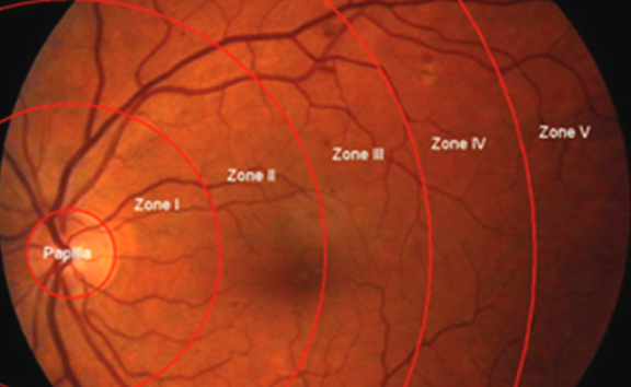C - reactive protein and chitinase 3-like protein 1 as biomarkers of spatial redistribution of retinal blood vessels on digital retinal photography in patients with diabetic retinopathy