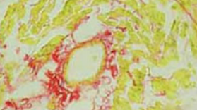 Anti-fibrotic effect of Aliskiren in rats with deoxycorticosterone induced myocardial fibrosis and its potential mechanism