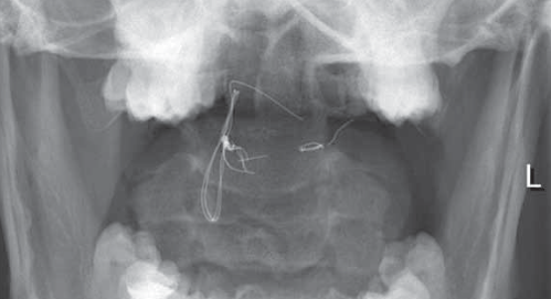 General anaesthesia in an adult patient with Morquio syndrome with emphasis on airway issues