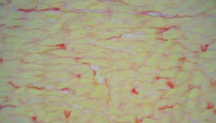 Glycogen accumulation in cardiomyocytes and cardiotoxic effects after 3NPA treatment