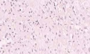 The significance of MGMT protein detection in evaluation of osteosarcoma necrosis rate after cisplatin chemotherapy