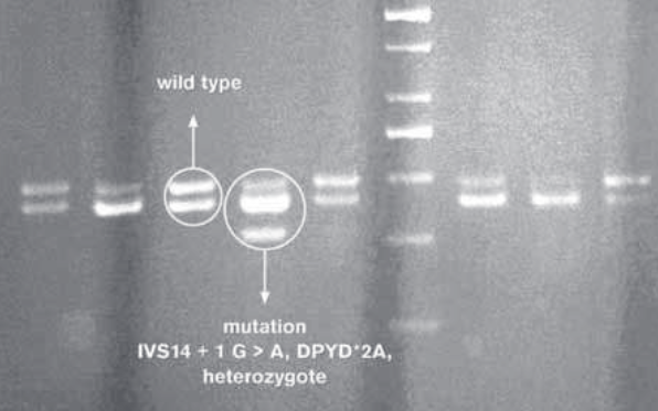 Investigation of Ivs14+1G>A Polymorphism of Dpyd Gene in a Group of Bosnian Patients Treated with 5-Fluorouracil and Capecitabine