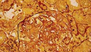 The Effect of Calcium Channel Blocker Verapamil on Gentamicin Nephrotoxicity in Rats