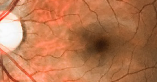 Electroneurography of Right Median and Ulnar Nerves in Diabetic Patients With and Without Retinopathy