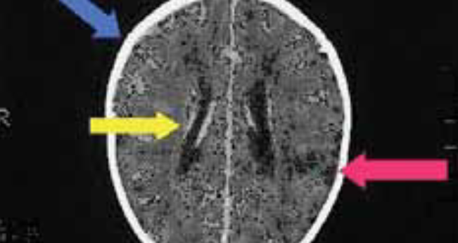 Listeria monocytogenes as the possible cause of the spontanous abortion in female of the fertile age