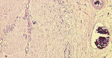 Histological changes of the sciatic nerve in dogs after intraneural application of lidocaine--relation to the established application pressure