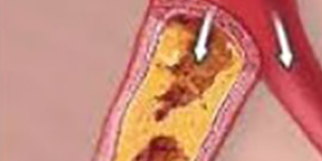Pathohistological changes in diffuse coronary atherosclerosis and chronic infection caused by Chlamydia pneumonia