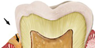 Endodontic-periodontal locally delivered antibiotics