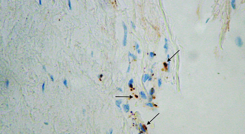 Vascular endothelial growth factor (VEGF)-related polymorphisms rs10738760 and rs6921438 are not risk factors for proliferative diabetic retinopathy (PDR) in patients with type 2 diabetes mellitus (T2DM)