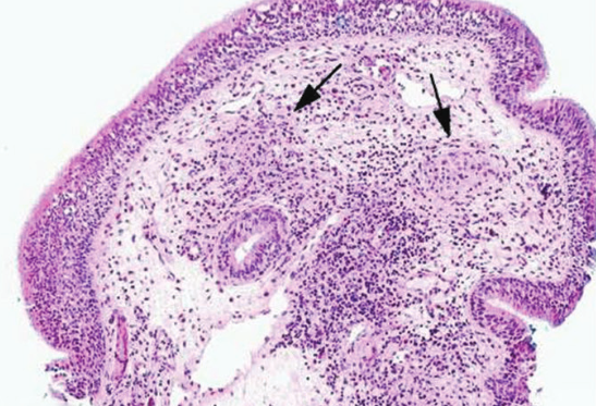 Laryngeal tuberculosis in renal transplant recipients: A case report and review of the literature