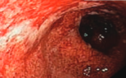 Dysbiosis of gut microbiota in inflammatory bowel disease:  Current therapies and potential for microbiota-modulating therapeutic approaches