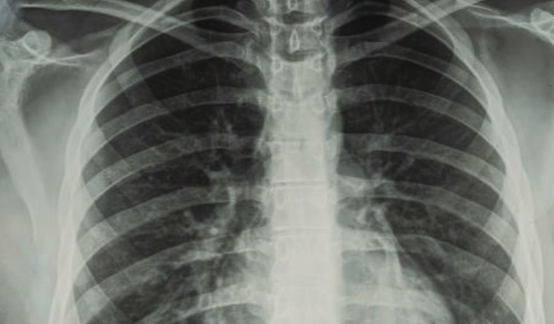 Kawasaki-like disease and acute myocarditis in the SARS-CoV-2 pandemic – reports of three adolescents
