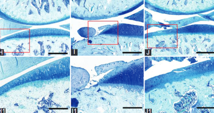 Raloxifene inhibits the overexpression of TGF-β1 in cartilage and regulates the metabolism of subchondral bone in rats with osteoporotic osteoarthritis