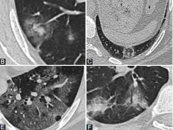 Predictive performance of CT for adverse outcomes among COVID-19 suspected patients: a two-center retrospective study