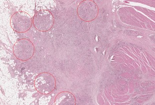 Poorly differentiated clusters and tumor budding are important prognostic factors in colorectal carcinomas