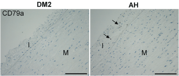 Inflammatory cells in the ascending aortic aneurysm in patients with type 2 diabetes versus patients with hypertension