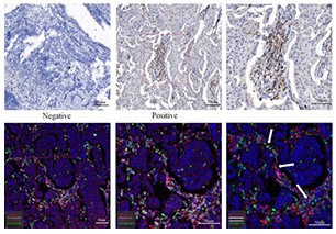 The expression of VISTA on CD4+ T cells associate with poor prognosis and immune status in non-small cell lung cancer