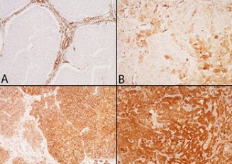 The association between NOTCH3 expression and the clinical outcome in the urothelial bladder cancer patients