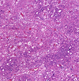 Small cell variant of chromophobe renal cell carcinoma: Clinicopathologic and molecular-genetic analysis of 10 cases