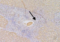 1 as a biomarker of increased vascular invasion and decreased sorafenib sensitivity in hepatocellular carcinoma
