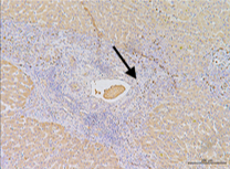 ORM 1 as a Biomarker of Increased Vascular Invasion and Decreased Sorafenib Sensitivity in Hepatocellular Carcinoma