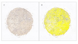 PLCE1 is a poor prognostic marker and may promote immune escape from osteosarcoma by the CD70-CD27 signaling