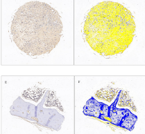 PLCE1 is a poor prognostic marker and may promote immune escape from osteosarcoma by the CD70-CD27 signaling pathway