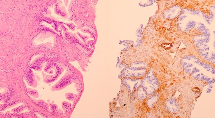 Methylation pattern of Caveolin-1 in prostate cancer as potential cfDNA biomarker