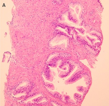 Methylation pattern of Caveolin-1 in prostate cancer as potential cfDNA biomarker