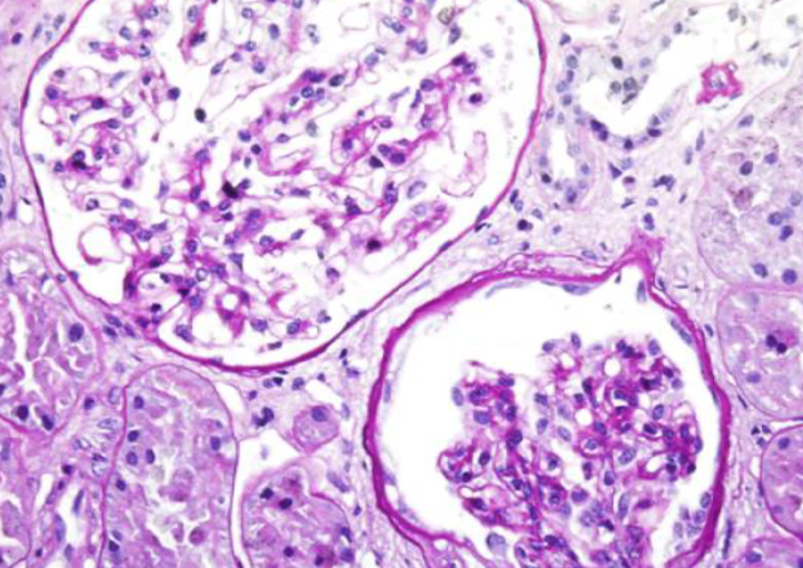 Clinical and histopathological characteristics of COL4A3 c.2881+1G>A variant causing Alport spectrum disorders