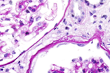 Clinical and histopathological characteristics of COL4A3 c.2881+1G>A variant causing Alport spectrum disorders