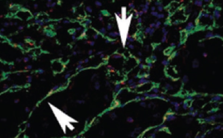 Prognostic and predictive significance of VEGF, CD31, and Ang-1 in patients with metastatic clear cell renal cell carcinoma treated with first-line sunitinib