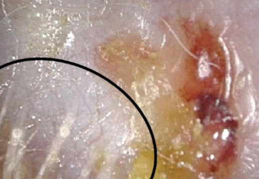 Acquired atresia of the external auditory canal and canaloplasty with Thiersch graft reconstruction: outcomes and complications