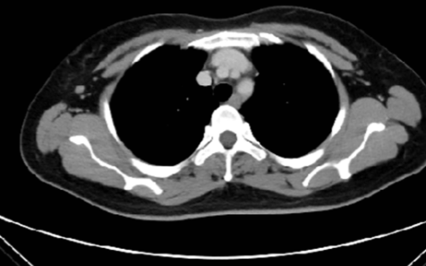 Development and validation of radiomics machine learning model based on contrast-enhanced computed tomography to predict axillary lymph node metastasis in breast cancer