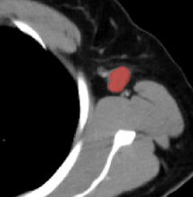 Development and validation of radiomics machine learning model based on contrast-enhanced computed tomography to predict axillary lymph node metastasis in breast cancer