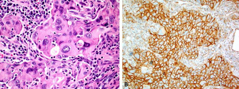 PD-L1 testing by immunohistochemistry in Immuno-Oncology