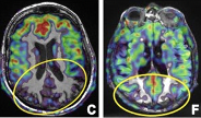 The role of magnetic resonance imaging in the diagnosis and prognosis of dementia