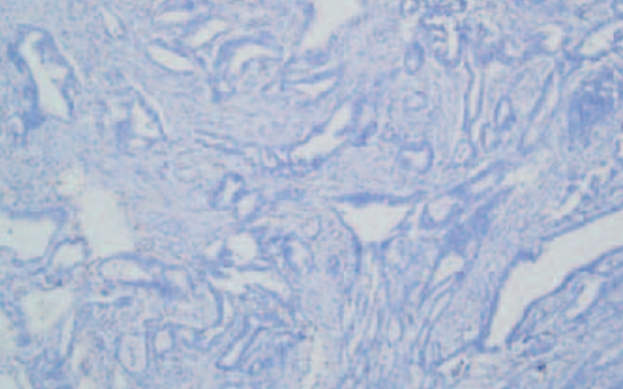 C5aR1 shapes a non-inflammatory tumor microenvironment and mediates immune evasion in gastric cancer